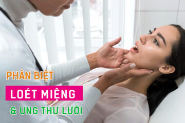 Phân biệt loét miệng và ung thư lưỡi